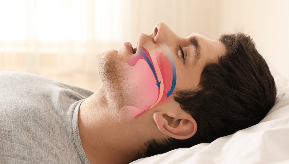 Obstructive Sleep Apnea